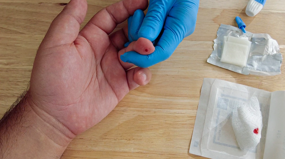 Sluggish Capillary Refill Time