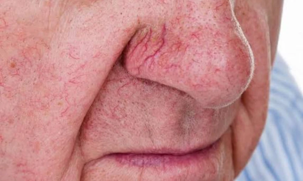 Spider Angiomas (Tiny Star-Shaped Blood Vessels)