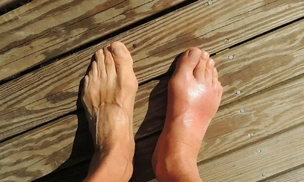 Swelling In Only One foot