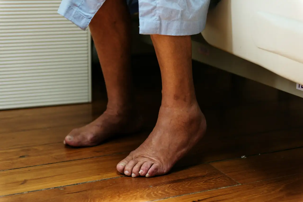 Swollen Feet Taking Off Your Socks