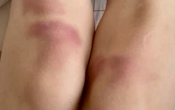 The Bruise Pattern That Changes a Hematologist’s Next Step