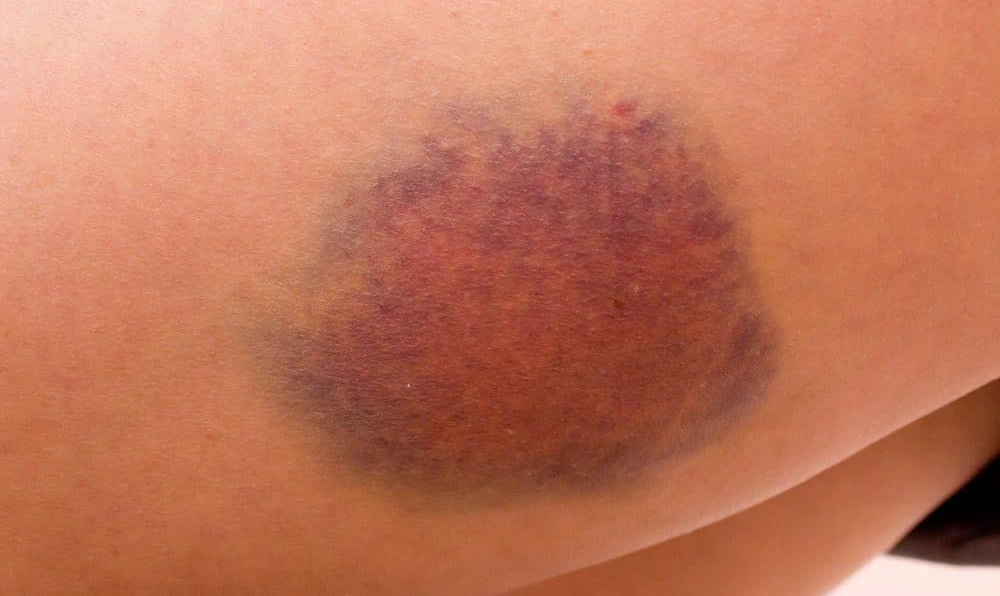 The Bruise Pattern To Remember