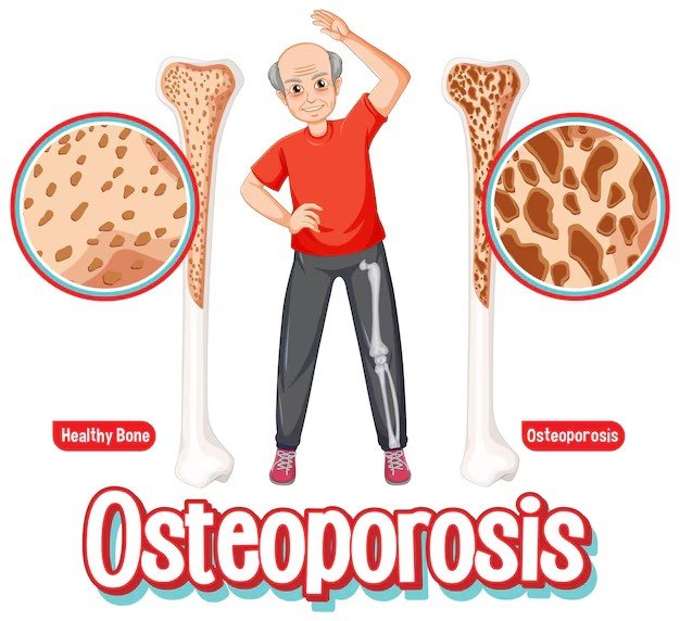 The Most Important Thing to Know About Weak Bones After 50