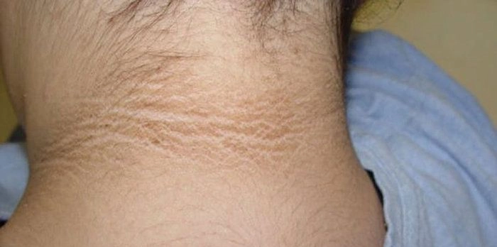 The Neck Skin Patch Endocrinologists Notice First