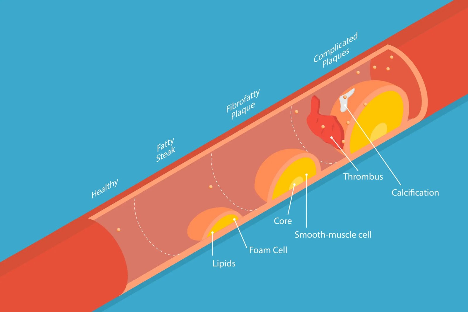 The Risk of Arterial Calcification