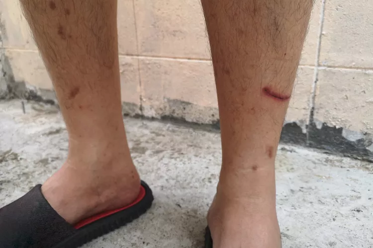 The Shin Spots People Mistake for Bruises