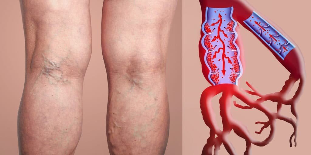 The Sudden Threat of Deep Vein Thrombosis