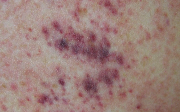 The Tiny Purple Spots That Doctors Take Seriously