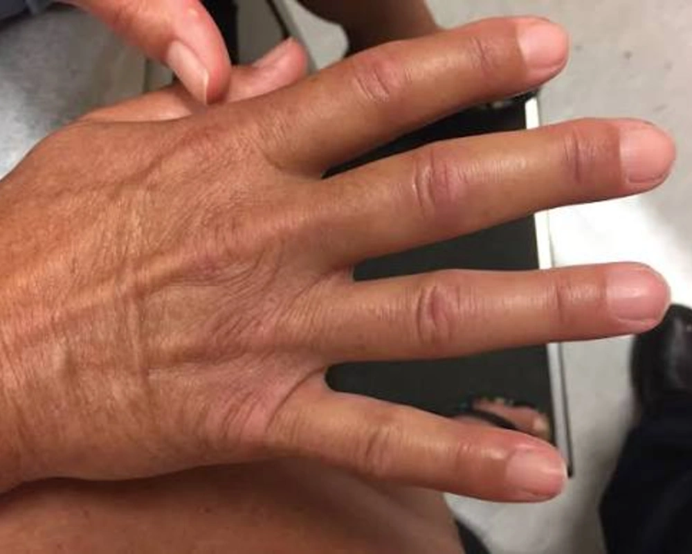 Tight, Waxy Skin on Your Hands