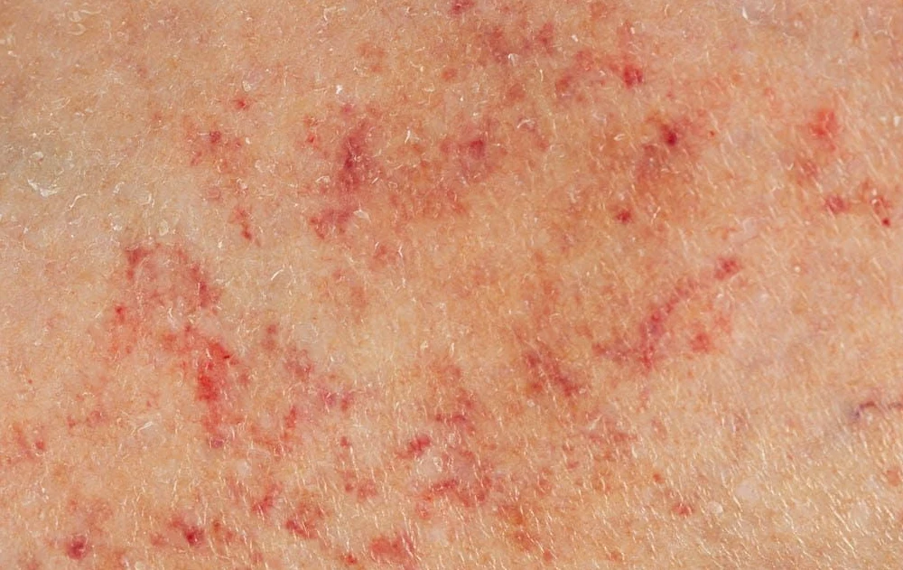Tiny Red or Purple Dots Under the Skin