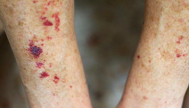 Tiny Red or Purple Spots That Do Not Blanch