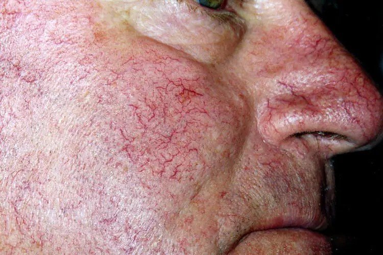 Tiny Spider-Shaped Blood Vessels