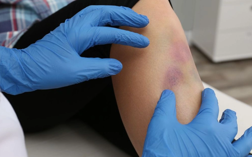 What Hematologists Look At When Evaluating Bruising