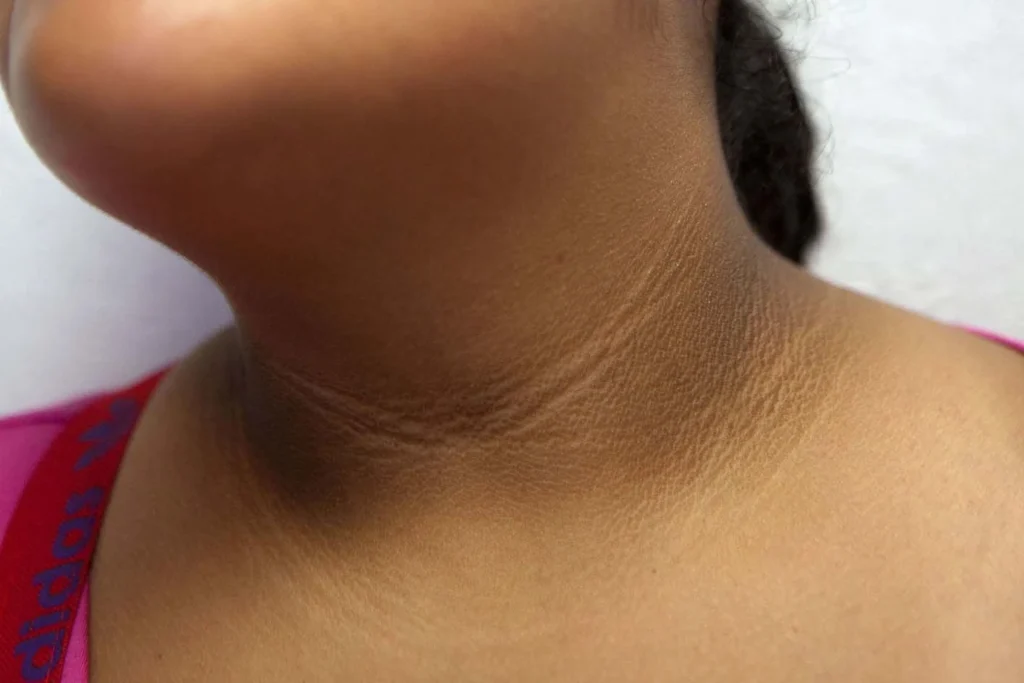 What Is That Dark Patch on Your Neck (Acanthosis Nigricans)