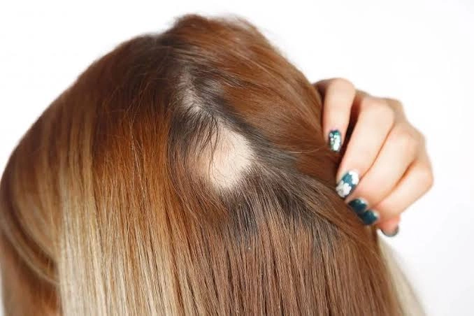 When Hair Loss Needs More Than A DIY Treatment