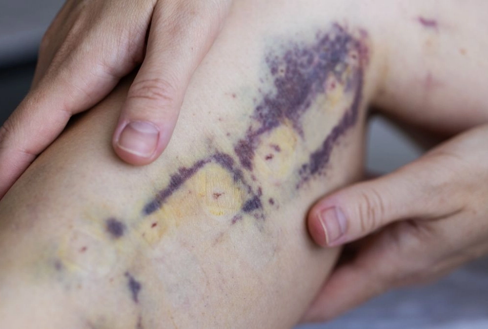 When Unexplained Bruising Needs Medical Attention