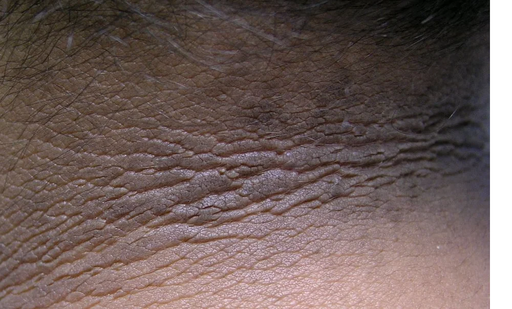 Why Acanthosis Nigricans Happens Inside the Body