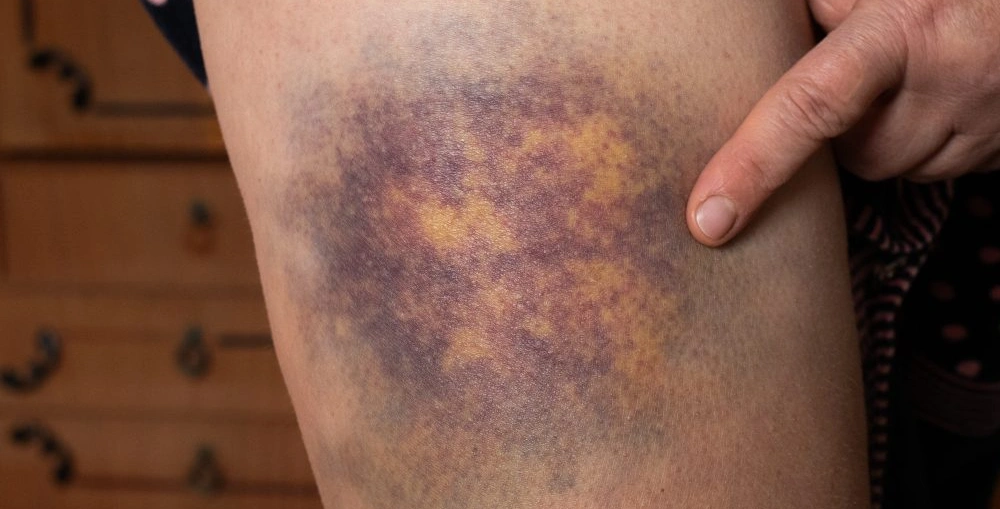 Why Hematologists Look at the Pattern, Not Just the Bruise