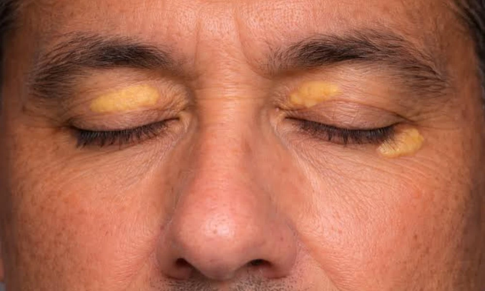 . Xanthelasma (Yellow Bumps on Eyelids)