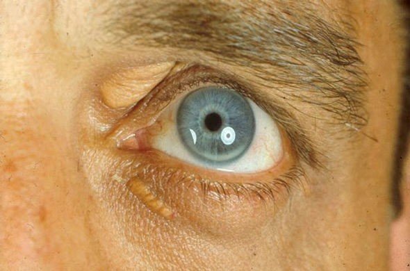Yellow Deposits Around the Eyelids
