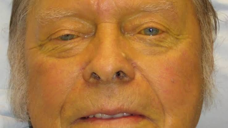 Yellowing That Shows Up in Your Skin or Eyes