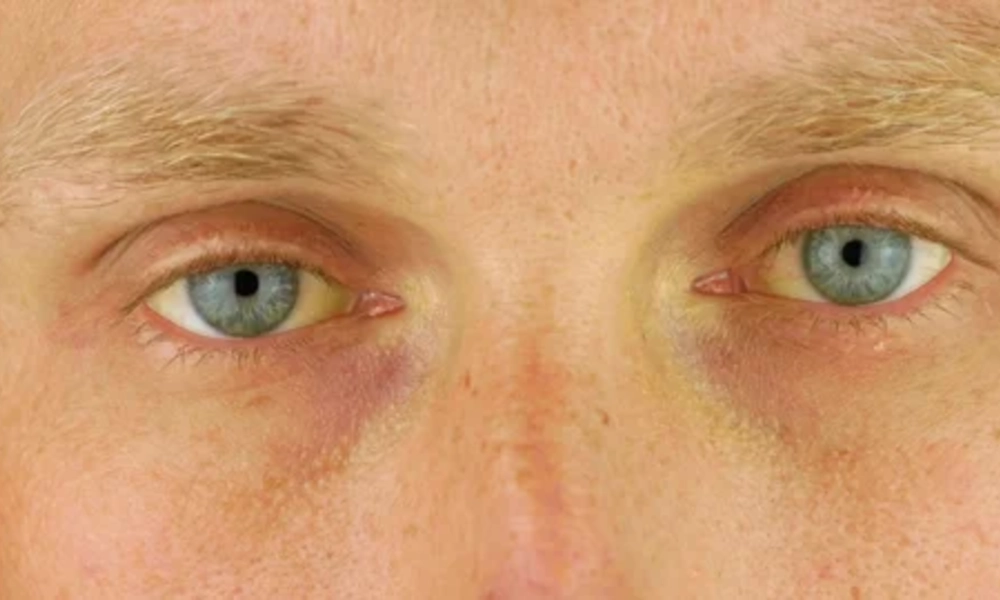 Yellowing of the Skin and Eyes (Jaundice)