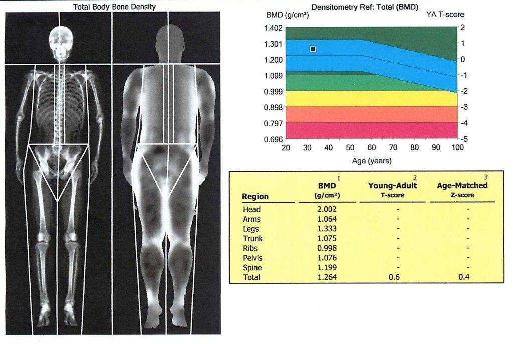 Your DXA Shows Low Bone Density
