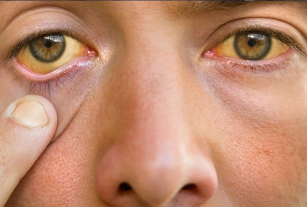 Your Skin or Eyes Have a Yellowish Tint