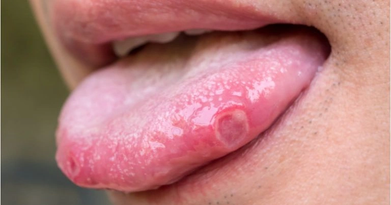 Your Tongue Is Sore, Red, or Strangely Smooth