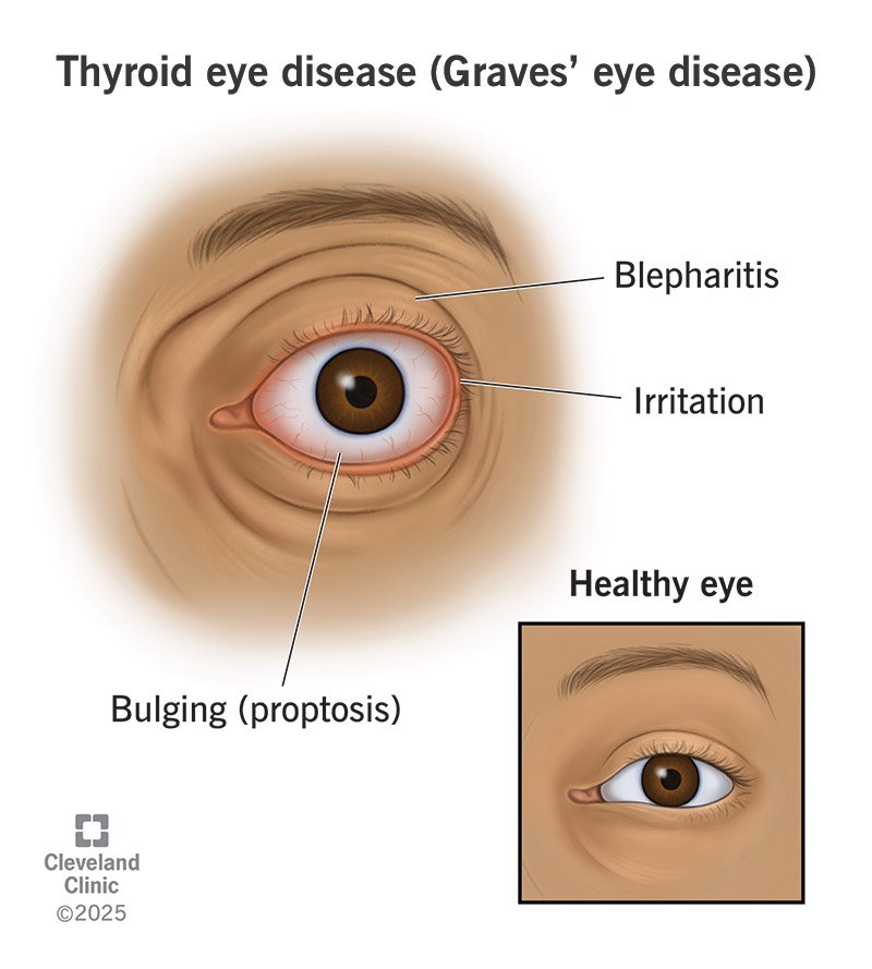Thyroid eye disease